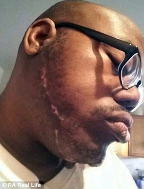 Chi phí xạ trị khá cao 20.000$ (hơn 450 triệu) và may mắn một vị bác sỹ đã chi trả giúp anh và nhiều mạnh thường quân cũng ủng hộ tiền để anh chi tiêu cho đám cưới của mình.