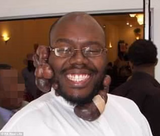 Những cây nấm thịt này không gây nhiều đau đớn nhưng nó ảnh hưởng đến thẩm mỹ và sự tự tin của anh trong những năm qua. Mỗi khi bước ra đường, mọi người nhìn anh như vật thể lạ vậy.