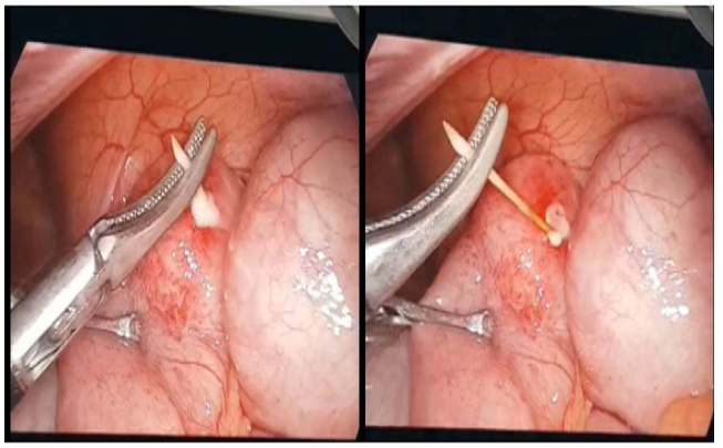 Be 8 tuoi thung ruot do nuot phai vat dung nha nao cung co