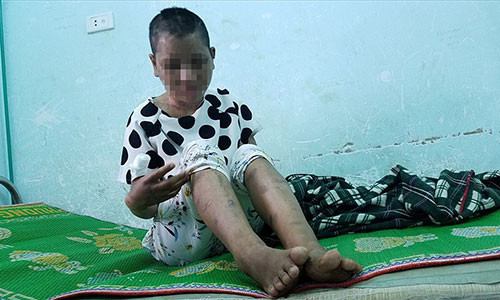 Chị Y Nhiêu đang chờ chuyển viện lên tuyến trên để điều trị các vết gãy xương. Ảnh: Đình Văn.