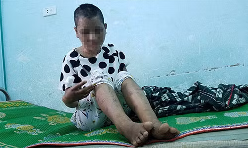 Chị Y Nhiêu đang chờ chuyển viện lên tuyến trên để điều trị các vết gãy xương. Ảnh: Đình Văn.