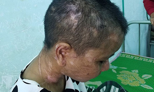 Khuôn mặt chị Y Nhiêu với chi chít vết sẹo. Ảnh Đình Văn