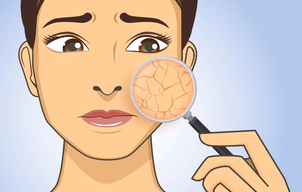 2. Da khô: Trên thực tế, da khô là một trong những dấu hiệu đầu tiên của tình trạng thiếu nước, có thể dẫn đến nhiều vấn đề lớn hơn. Thiếu nước có nghĩa là thiếu mồ hôi, dẫn đến cơ thể không có khả năng để rửa trôi các chất bẩn dư thừa và dầu tích tụ trong suốt cả ngày. Nếu bạn muốn ngăn ngừa mụn trứng cá, hãy uống nước nhiều hơn nữa. Ảnh: Newsfos.