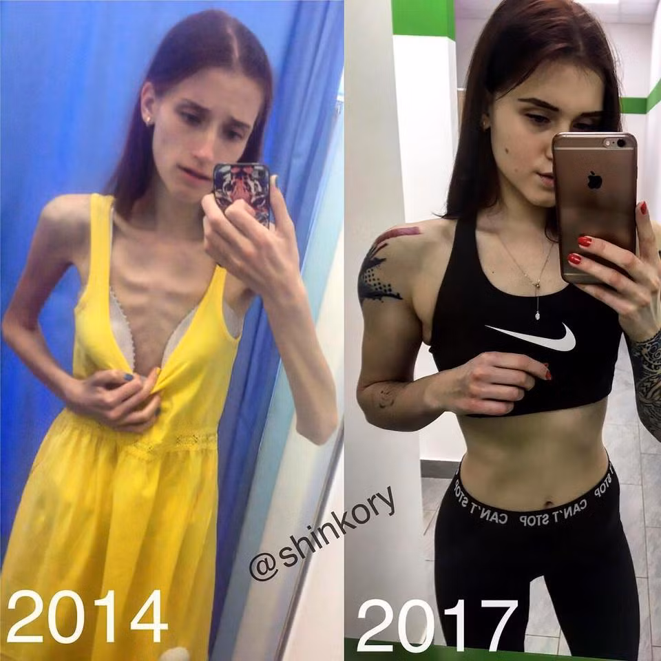 Thiếu nữ 18 tuổi ở Nga đã chia sẻ những loạt ảnh cho thấy những thay đổi ngoạn mục của cô từ "trơ xương" thành huấn luyện viên thể dục gợi cảm lên mạng xã hội nhằm truyền cảm hứng cho những người cũng mắc chứng chán ăn. Ảnh: CEN.