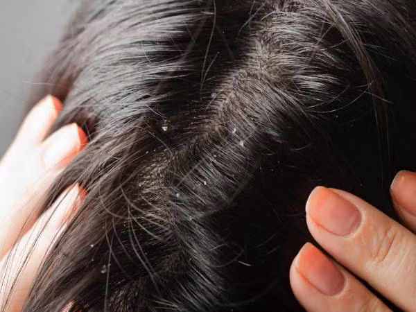 11. Loại bỏ gàu và tóc gãy: Gàu là một hiện tượng các mảng bám bong tróc xuất hiện trên da đầu gây ngứa ngáy khó chịu và kém tự tin. Nguyên nhân của căn bệnh này do các loại nấm gây ra. Trong thành phần của tinh dầu neem có hoạt chất chống khuẩn và diệt nấm, chỉ cần kết hợp vài giọt tinh dầu neem cùng dầu gội đầu, bạn sẽ đánh bay gàu nhanh chóng, trả lại cho bạn mái tóc bóng mượt và sạch gàu hơn. Ảnh: Boldsky.