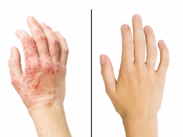 6. Chữa bệnh chàm Eczema: Eczema là một bệnh tự miễn dịch của da, gây khô da và ngứa. Dầu neem giúp làm giảm tình trạng khô và ngăn ngừa các nhiễm khuẩn thứ phát do vi khuẩn. Ảnh: Boldsky.