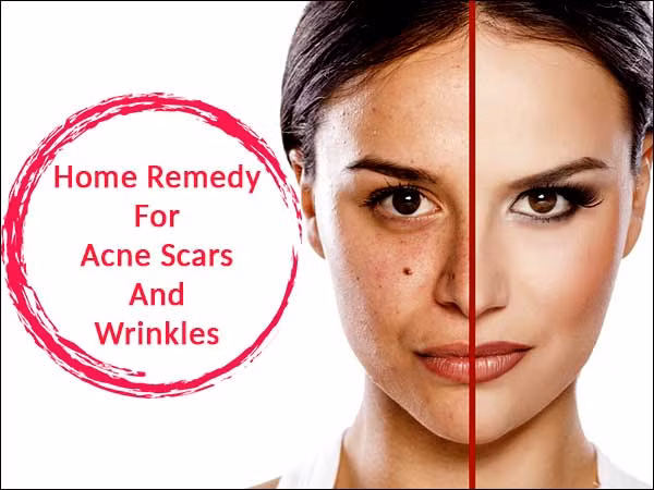 8. Loại bỏ sẹo: Tinh dầu lá neem được xem là một bài thuốc hiệu quả loại bỏ những vết sẹo khó ưa cho những người bị mụn trứng cá. Lượng axit béo trong dầu neem rất tốt khi làm chặt các lỗ chân lông, loại bỏ các tạp chất và tẩy vết sẹo do mụn gây ra. Ảnh: Boldsky.