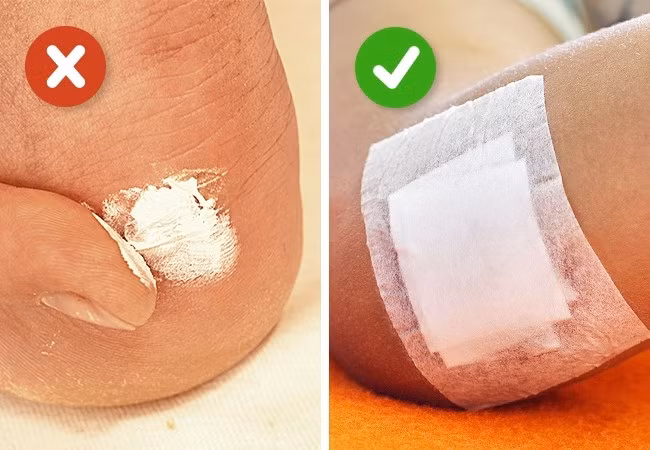 1. Bôi kem mỡ vào vết thương: Đây là một trong những sai lầm sơ cứu vết thương mà nhiều người mắc phải bởi thuốc mỡ có thể tạo ra độ ẩm không mong muốn cho vết thương. Thông thường, vết thương sẽ nhanh lành hơn trong không khí tự nhiên. Hoặc nếu bạn sợ vết thương dính bụi thì hãy dùng băng khô để cuốn lại. Ảnh: Brightside.