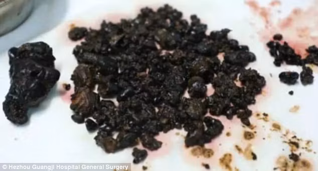 Phu nu TQ co 200 vien soi trong bung vi nhin an sang