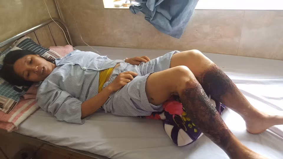 Bà Lê Thị Lan (50 tuổi, trú tại thôn Kênh Trạch, xã Hưng Nhân, huyện Vĩnh Bảo) đang được điều trị ở Bệnh viện Kiến An, Hải Phòng vì 2 chân bị bỏng nặng là nạn nhân của vụ việc trên.