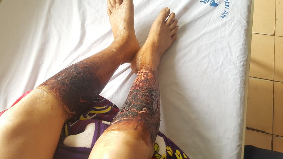 Nạn nhân được gia đình đưa đi viện cấp cứu. Kết qủa xác định bà Lan bị bỏng hóa chất, dẫn đến nhiễm độc nặng.