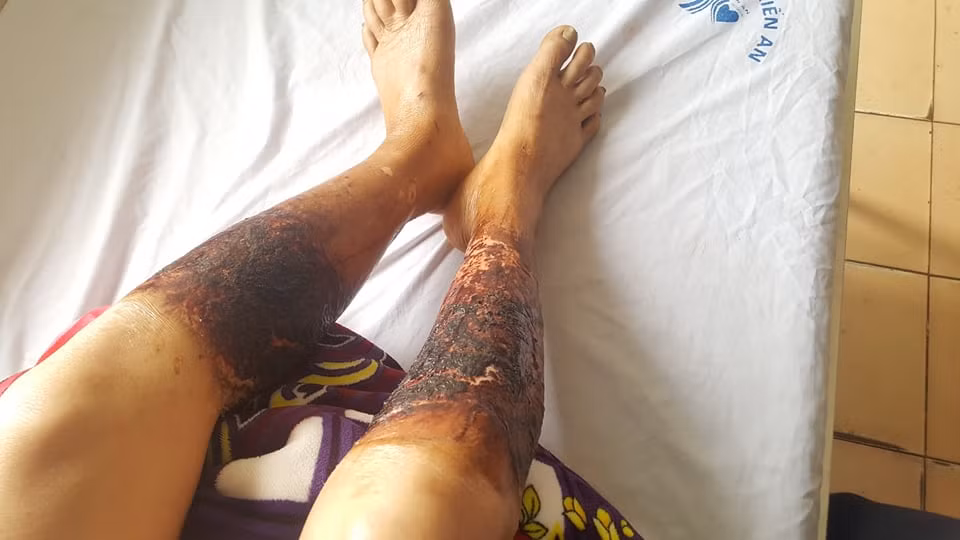 Nạn nhân được gia đình đưa đi viện cấp cứu. Kết qủa xác định bà Lan bị bỏng hóa chất, dẫn đến nhiễm độc nặng.