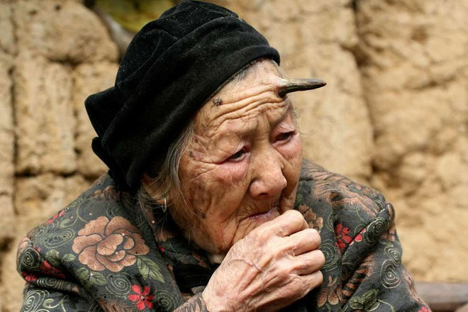 Người lớn tuổi, đặc biệt trong độ tuổi 60-70, có nguy cơ mắc sừng da cao hơn những nhóm tuổi khác. Cả hai giới đều có nguy cơ mắc phải tình trạng sừng da nhưng không có khả năng truyền nhiễm. Cách điều trị phổ biến nhất cho sừng da là phẫu thuật loại bỏ.