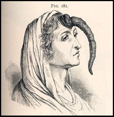 Vì vậy, bà Dimanche tiến hành ca phẫu thuật loại bỏ sừng thành công. Cuộc sống của bà trở lại bình thường.