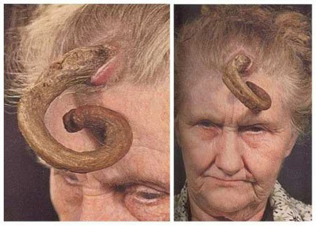 Khi khoa học phát triển, các chuyên gia lý giải vì sao con người mọc sừng trên đầu. Khoa học gọi đây là sừng da. Đây là tình trạng tổn thương hoặc tăng trưởng xuất hiện trên da. Chiếc sừng mọc trên đầu của con người được hình thành từ keratin - loại protein tạo nên lớp trên cùng của da. Nó có thể thay đổi kích thước tùy theo tốc độ phát triển ở mỗi trường hợp.