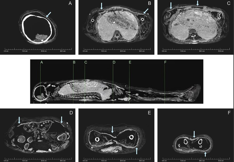 Từ đây, các chuyên gia suy đoán có thể một tay lái buôn đã đặt xác ướp người phụ nữ vào quan tài có niên đại thấp hơn để bán được với giá cao.