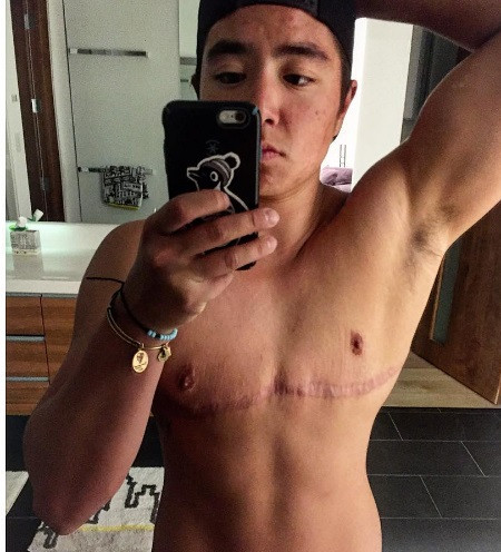 Vận động viên phẫu thuật cắt ngực để lại không ngần ngại khoe dài trên trang Instagram của mình.