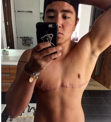 Vận động viên phẫu thuật cắt ngực để lại không ngần ngại khoe dài trên trang Instagram của mình.