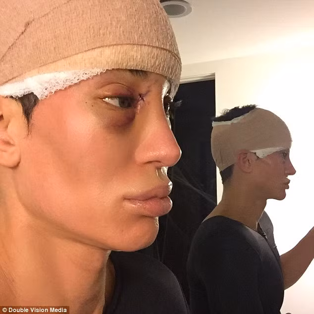 Búp bê sống Justin sau ca phẫu thuật loại bỏ tĩnh mạch trên trán.