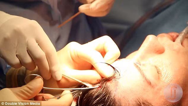 Các bác sĩ đang thực hiện thủ thuật loại bỏ tĩnh mạch trên trán của búp bê sống.