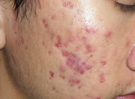 Ngoài ra, khi da bị mụn quá lâu và quá nhiều mà không được điều trị thích hợp, sẽ gây nên sự hoại tử ở những vết mụn mủ, mụn bọc. Từ đó, các khối mô sẽ bị mất đi tạo nên những vết lõm hay còn gọi là sẹo rổ trên khuôn mặt.