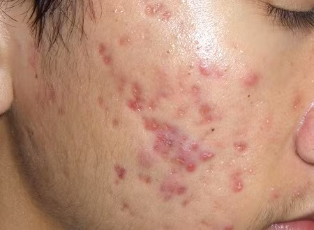 Ngoài ra, khi da bị mụn quá lâu và quá nhiều mà không được điều trị thích hợp, sẽ gây nên sự hoại tử ở những vết mụn mủ, mụn bọc. Từ đó, các khối mô sẽ bị mất đi tạo nên những vết lõm hay còn gọi là sẹo rổ trên khuôn mặt.