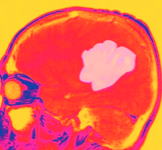 U não nguyên phát.