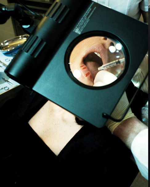 Bờ môi rớm máu đau đớn khi tiêm chất làm đầy.