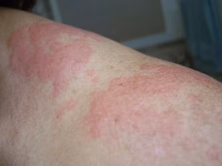  Mua đồ lót quá rẻ tiền. Đã từng có trường hợp được ghi nhận là bị dị ứng tương tự như triệu chứng bệnh eczema, nguyên nhân là do chất chun cao su trong quần lót khiến cơ thể đổ mổ hôi, gây dị ứng. Ngoài ra còn các yếu tố khác cũng có thể gây dị ứng như các hợp chất PPD được sử dụng như thuốc nhuộm vải kém chất lượng. 