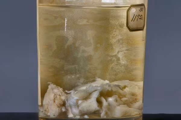 Khối u của cựu Tổng thống Mỹ Grover Cleveland được bảo quản và trưng bày tại viện bảo tàng Philadelphia Mutter.