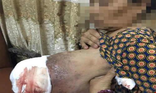 Hai hung hoai tu vu, nhiem trung nang vi thuoc nam