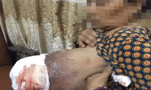 Hai hung hoai tu vu, nhiem trung nang vi thuoc nam