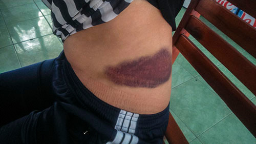 Vết thương lớn ở vùng hông của chị Th. do bị Bắc đánh.