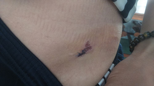 Những vết rách phải khâu trên cơ thể chị Th. do bị Bắc hành hung vẫn chưa khỏi.