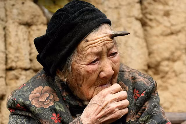 Bà Zhang Ruifang được mệnh danh là “bà dê” bởi sở hữu một chiếc sừng lớn đến 2 inch (hơn 5cm) trên trán. Bà bắt đầu mọc sừng từ khi chạm mốc 100 tuổi. Các bác sĩ không biết đây là bệnh gì nhưng có thể phán đoán chiếc sừng giống như một khối u sắc tố, được tạo thành từ protein keratin tạo nên tóc, móng, sừng ở động vật. Đặc biệt, mẹ và bà ngoại của bà Zhang cũng mọc sừng khi về già.