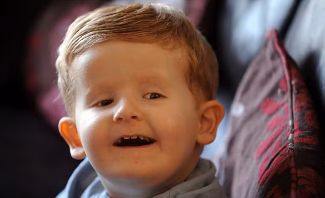 Mới sinh ra, bé Alfie đã bị mù và khiếm khuyết một số năng lực. Các xét nghiệm tiết lộ rằng nhiễm sắc thể thứ 7 của cậu bé bị lỗi và có thêm một chuỗi ADN mà các bác sĩ chưa bao giờ nghe nói đến. Hiện tại, Alfie vẫn phát triển bình thường nhưng gặp phải một số vấn đề sức khỏe như tiêu hóa kém, không thể chuyển hóa một số chất dinh dưỡng và suy nhược cơ.