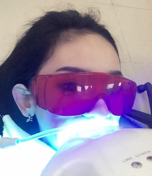 Để có được những điều này, Thúy Vi đã trải qua nhiều lần phẫu thuật thẩm mỹ để cắt mí, nâng mũi… Tất cả những lần đụng dao kéo để làm đẹp, Thúy Vi đều công khai, chia sẻ thông tin. Tuy nhiên, lần sửa răng mới đây của cô nàng tai tiếng này lại được thực hiện trong im lặng.