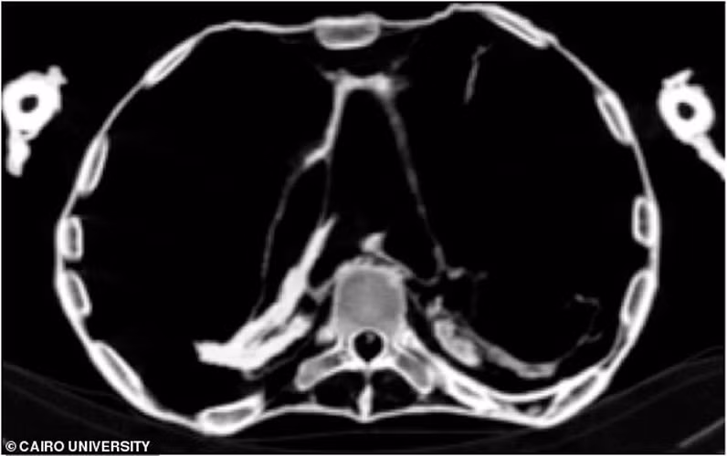 Do đó, thi hài công chúa đã co cứng. Những thợ ướp xác không thể giúp Meret Amun có diện mạo xinh đẹp hơn khi sang thế giới bên kia. Vì vậy, xác ướp công chúa có gương mặt đau đớn y như lúc qua đời.