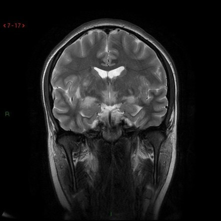 Trong khi các nhà khoa học chưa tìm ra lời giải chính xác về nguồn gốc căn bệnh, một giả thuyết cho rằng, căn bệnh Encephalitis lethargica có thể do một chủng vi khuẩn liên cầu hiếm gặp. Đây là loại vi khuẩn gây ra nhiều đợt viêm họng mỗi năm gây ra.