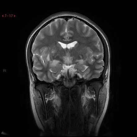 Trong khi các nhà khoa học chưa tìm ra lời giải chính xác về nguồn gốc căn bệnh, một giả thuyết cho rằng, căn bệnh Encephalitis lethargica có thể do một chủng vi khuẩn liên cầu hiếm gặp. Đây là loại vi khuẩn gây ra nhiều đợt viêm họng mỗi năm gây ra.