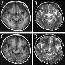 Căn bệnh bí ẩn này lan truyền qua giọt bắn li ti trong không khí. Tuy nhiên, các chuyên gia không thể xác định được nó do loại virus nào gây ra.