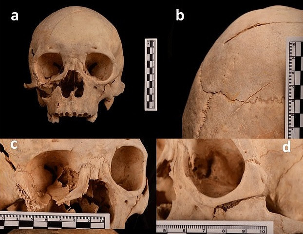 Sau khi kiểm tra tỉ mỉ bộ hài cốt, các chuyên gia phát hiện trên thi hài của người đàn ông có 13 vết thương do vật sắc nhọn hình chữ V gây ra. Trong số này, vết thương ở xương sườn là nguyên nhân chính gây ra cái chết của ông.