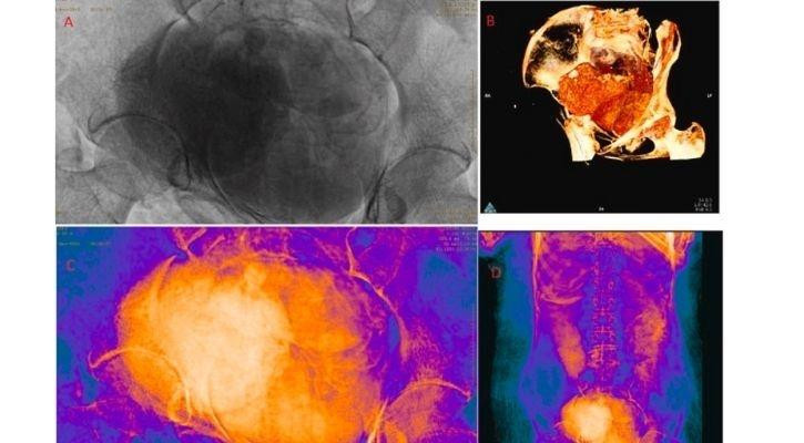 Để tìm ra câu trả lời chính xác về nguyên nhân tử vong của thai phụ trên và những bí ẩn khác, các chuyên gia sẽ cần thêm thời gian.