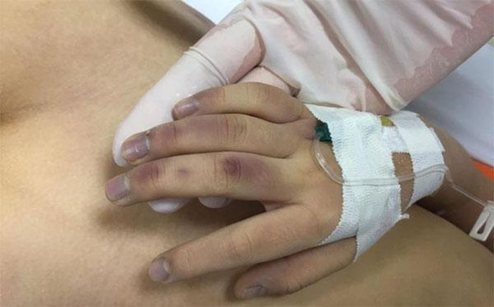 Nguyên nhân chết của cháu bé được xác định: Ngạt do trào ngược thức ăn, hậu quả của sốc chấn thương. Thương tích trên cơ thể do tác động vật tày gây ra. Luật sư Thơm cho rằng, như vậy, có thể thấy bị can sử dụng vật tày đánh cháu bé gián tiếp gây nên cái chết cho cháu (Cố ý về hành vi, vô ý về hậu quả) Do đó, hành vi phạm tội của bị can đã cấu thành tội Cố ý gây thương tích theo Điều 134 BLHS là có căn cứ, đúng quy định của pháp luật. 