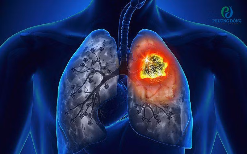 O nhiem khong khi va ung thu phoi co lien quan mat thiet