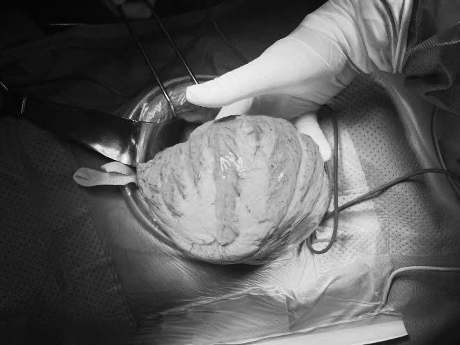 Nguoi dan ong “chua phan” do phinh dai trang bam sinh