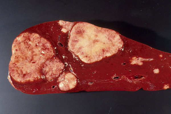 Can benh ung thu dung dau Viet Nam: Vi sao khi co dau hieu benh da muon?-Hinh-2