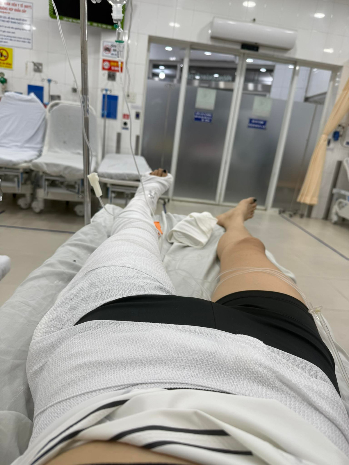 Mới đây trên trang cá nhân của mình, siêu mẫu Kỳ Hân vừa đăng tải hình ảnh nằm trong bệnh viện với đôi chân bị bó bột trắng xóa khiến người hâm mộ không khỏi lo lắng. Cô nàng bày tỏ: "Cứ tưởng mình tìm được môn thể thao chân ái của đời mình, mà giờ gãy xương đùi rồi".