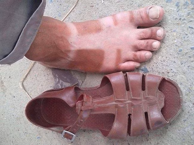 Hậu quả của việc cả mùa hè chỉ đi đúng một đôi dép. Ảnh: Tổng hợp