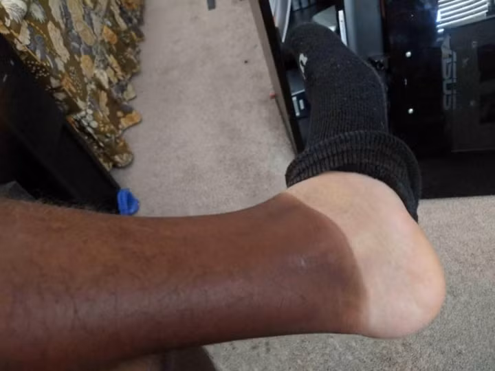 Dẫu biết là còn có kem chống nắng nhưng có lẽ chúng cũng không thể đánh bại được những tia nắng chói chang của mặt trời mà cho ra đời không ít "thảm cảnh" cháy nắng.